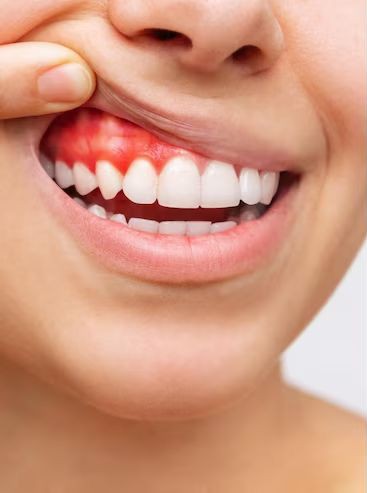 قبل العلاج — لثة محمرة مع نزيف